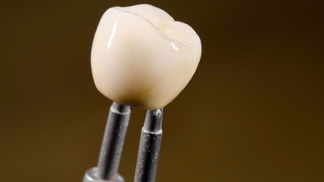 Dental Crowns in Edmonton AB Esthetic Porcelain Crowns