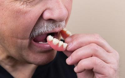 Dentures Veneers Crowns in Edmonton