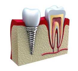 Dental Implants Edmonton AB