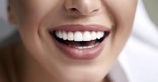 porcelain veneers