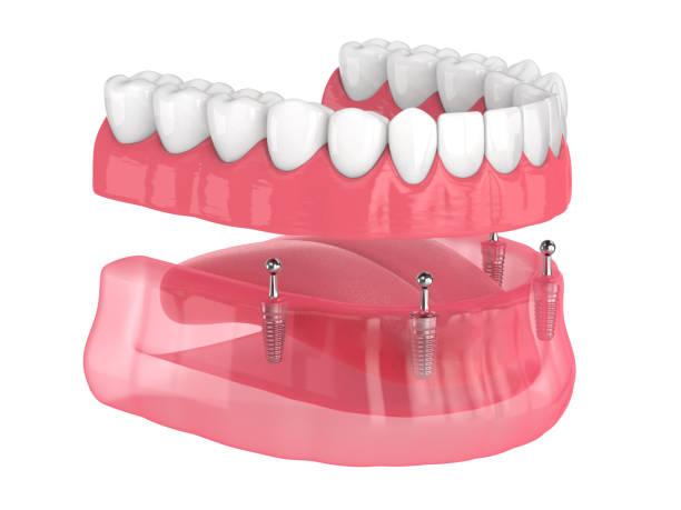 dentures Edmonton
