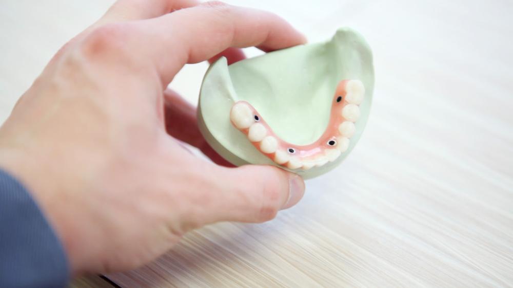 How Dental Crowns are Made
