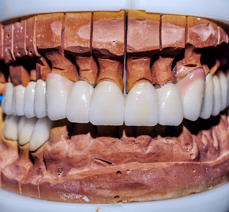 Facts about dentures in Edmonton