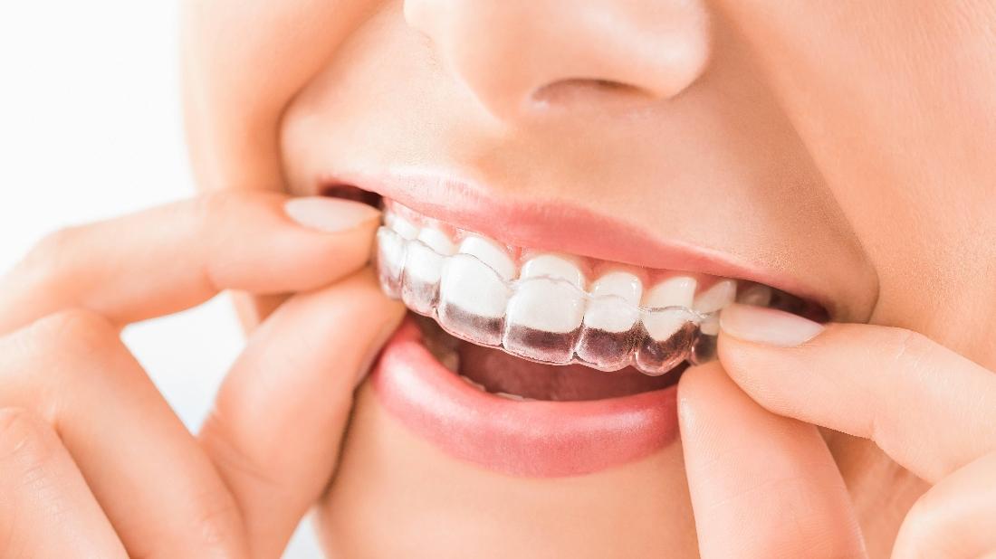 Edmonton AB Invisalign Provider Clear Braces for Adults
