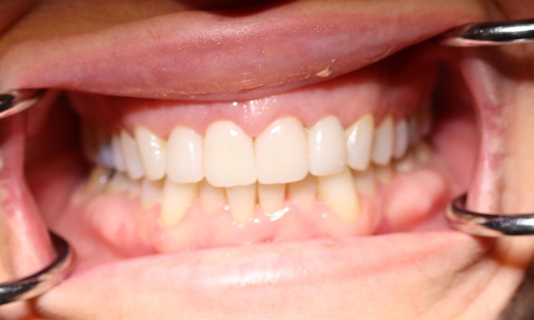 After Cosmetic Veneers