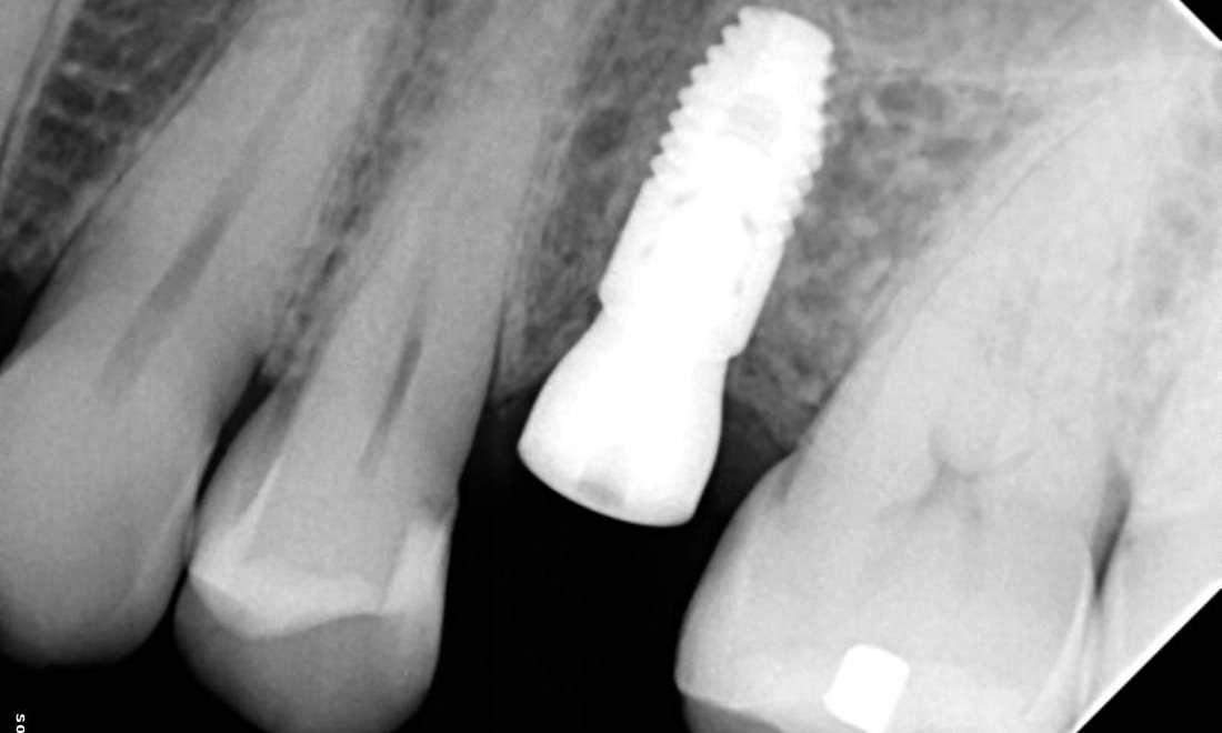 Upper Dental Implant Placement