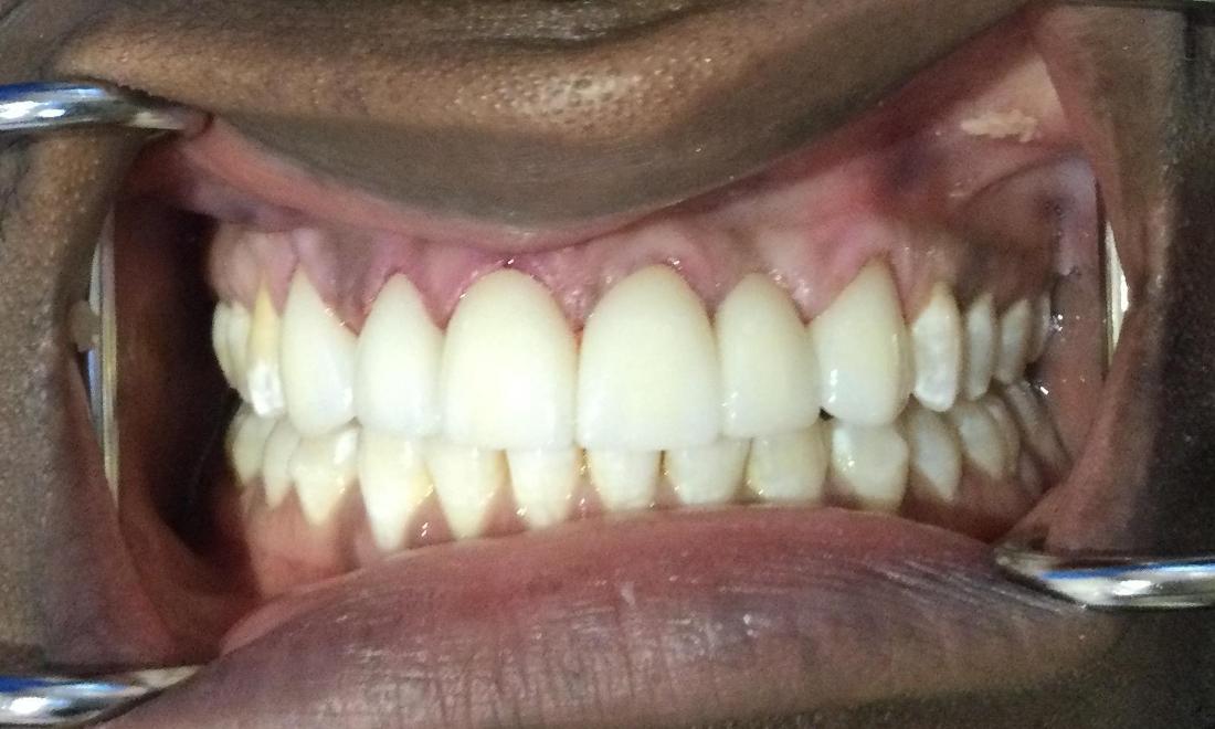 Norbert After Crowns and Invisalign Treatment