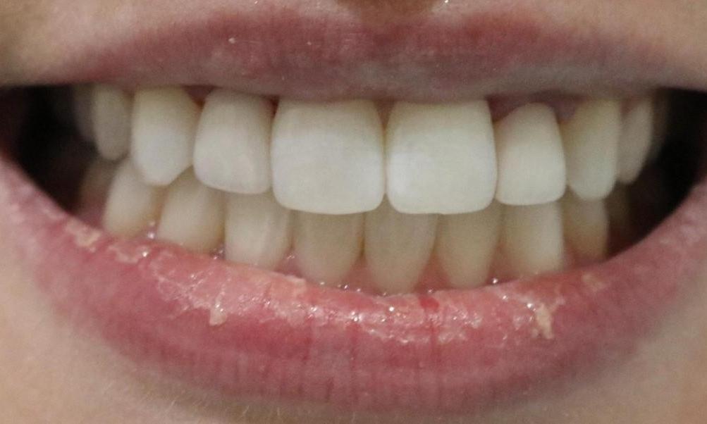 Melissa After Invisalign and Veneers
