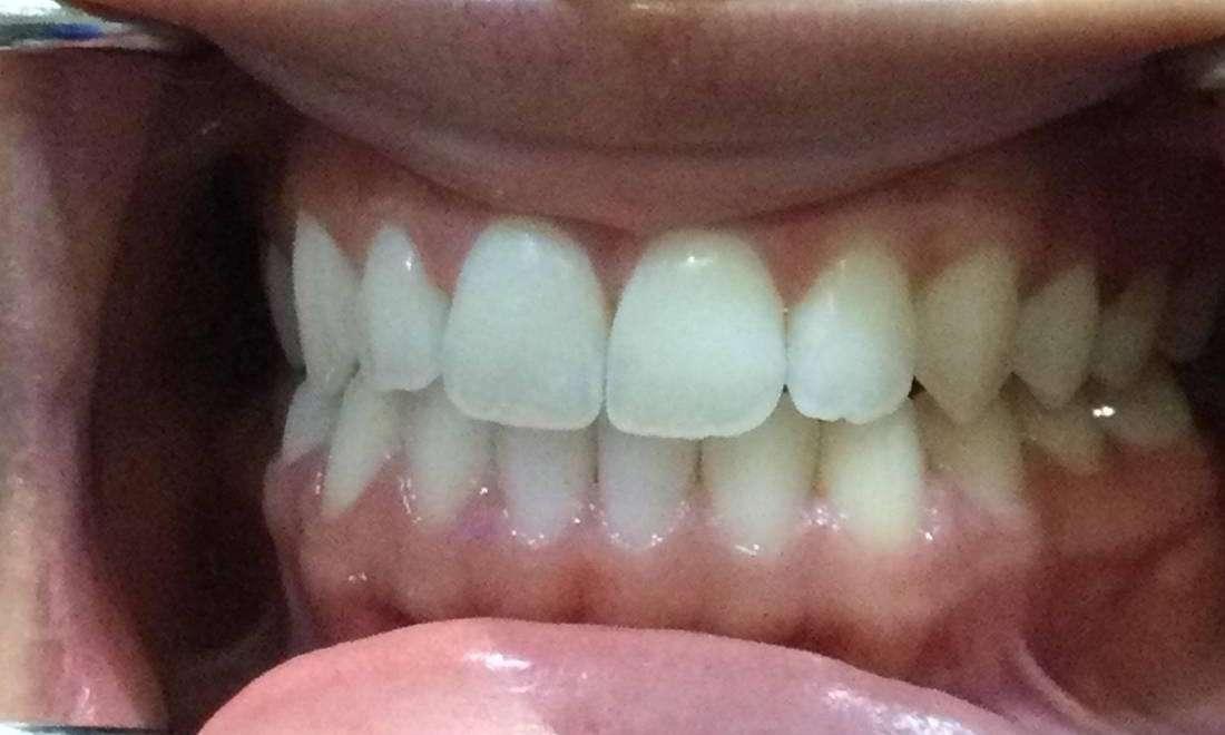 Upper and Lower Invisalign Treatment 