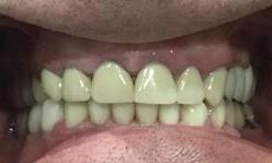 Ron A After Treatment