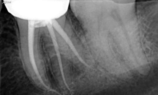 Posterior Root Canal 
