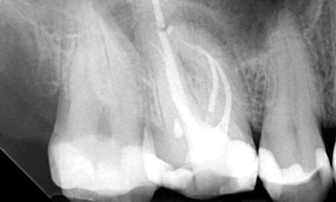 Root Canal Treatment and Full Coverage Crown