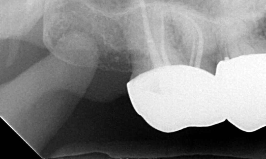 Root Canal Treatment - Upper Molar