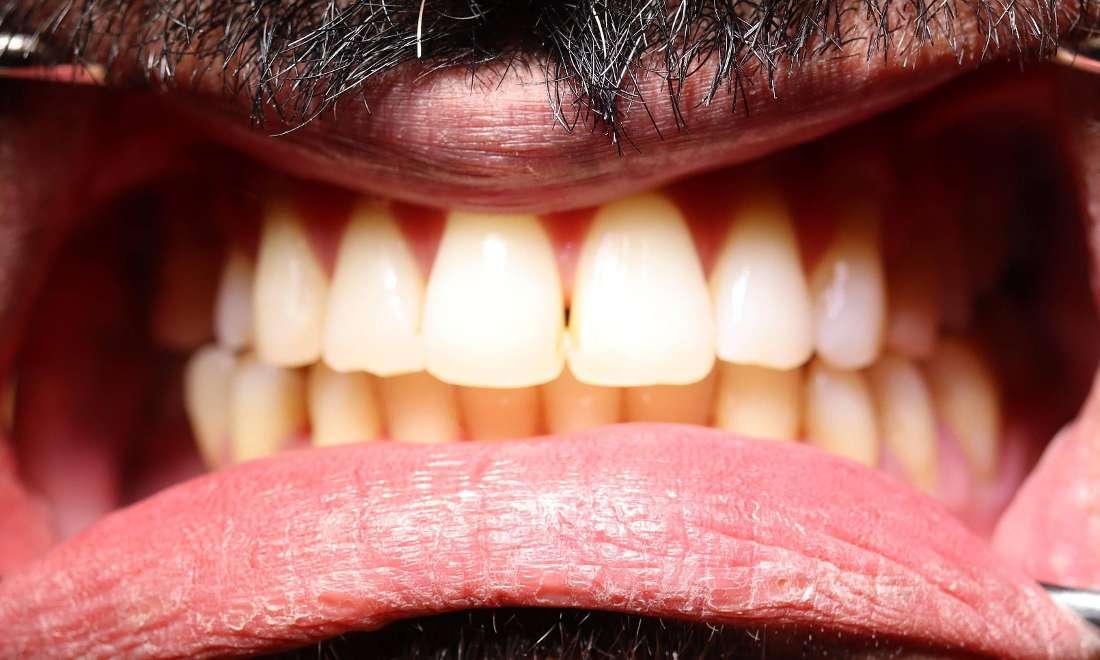 Upper and Lower Invisalign treatment