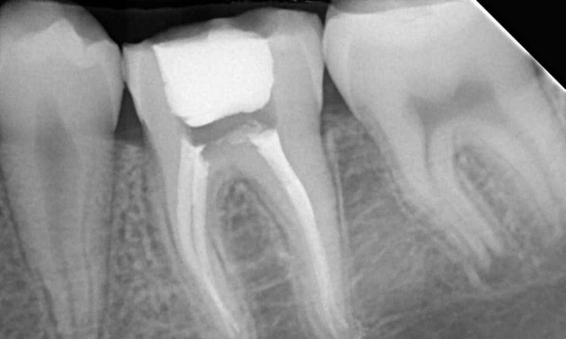 Root Canal Treatment