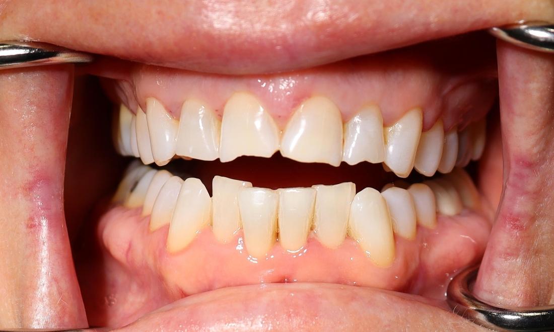 Before cosmetic veneers 