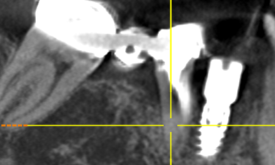 Before Crowns and Single Dental Implant