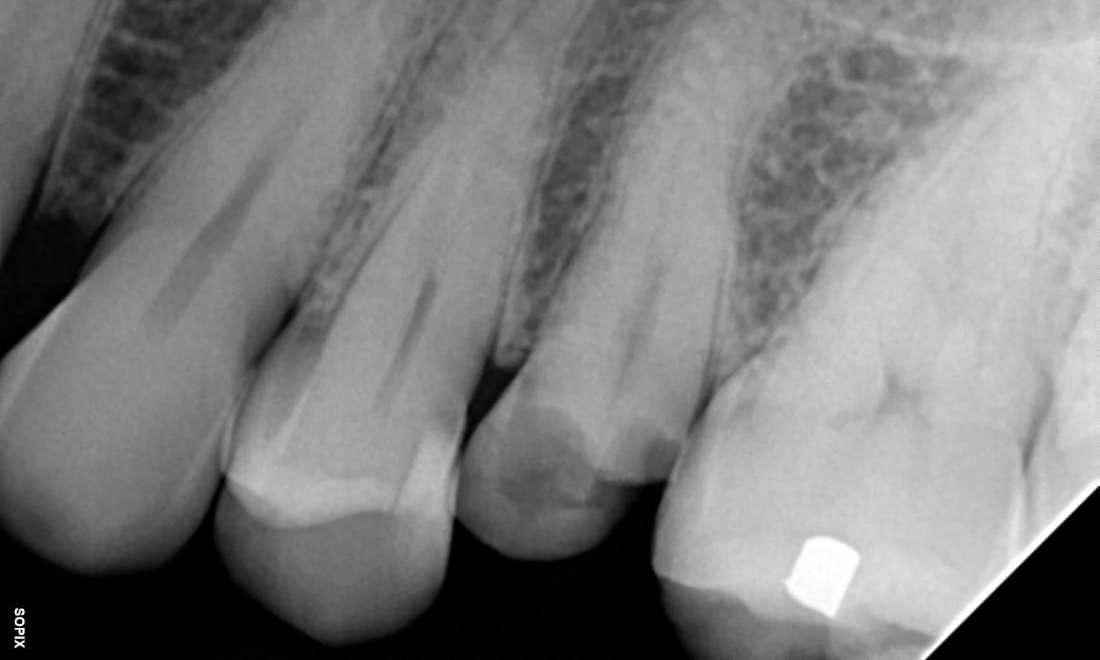 Upper Dental Implant Placement