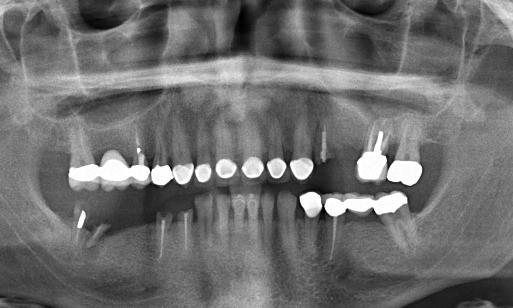 Ron Before Dental Implants, Bridges & Crowns