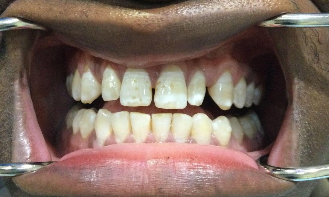 Norbert Before Crowns and Invisalign Treatment