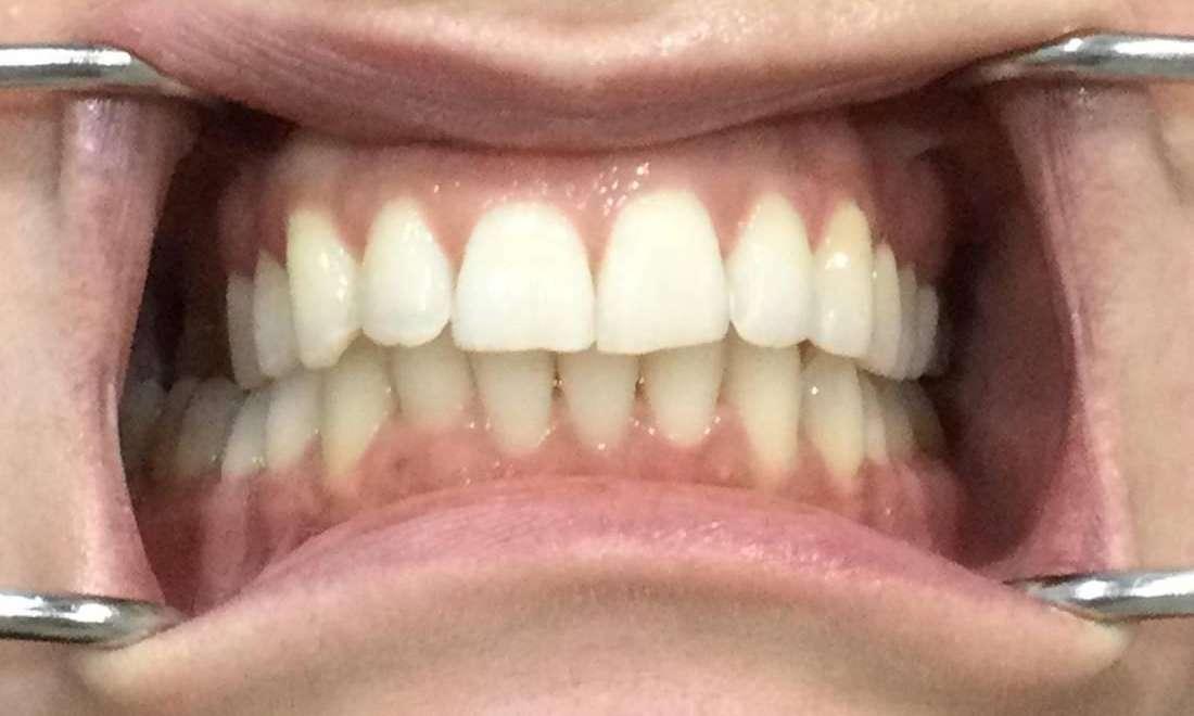 Upper and Lower Invisalign Treatment 