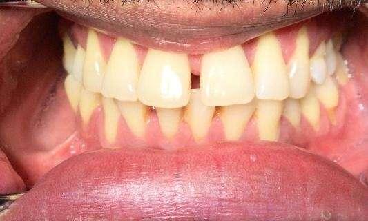Upper and Lower Invisalign treatment