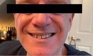 Hans Kohl Before treatment