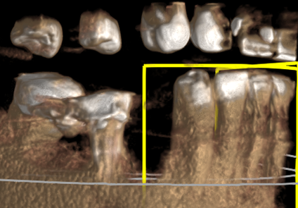 Second picture before crowns and single dental implant